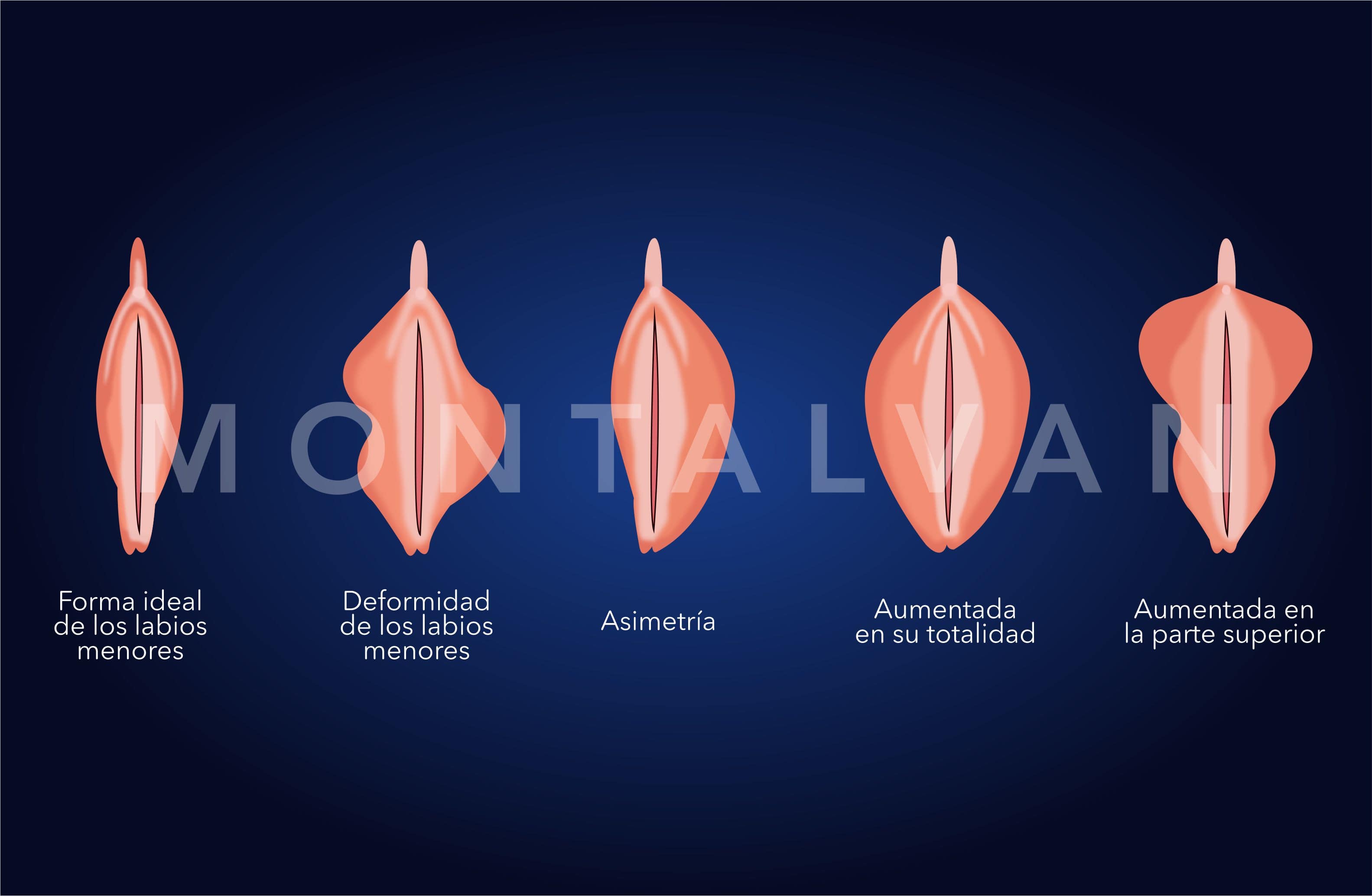 Tipos de vulvas. Partes de la vulva