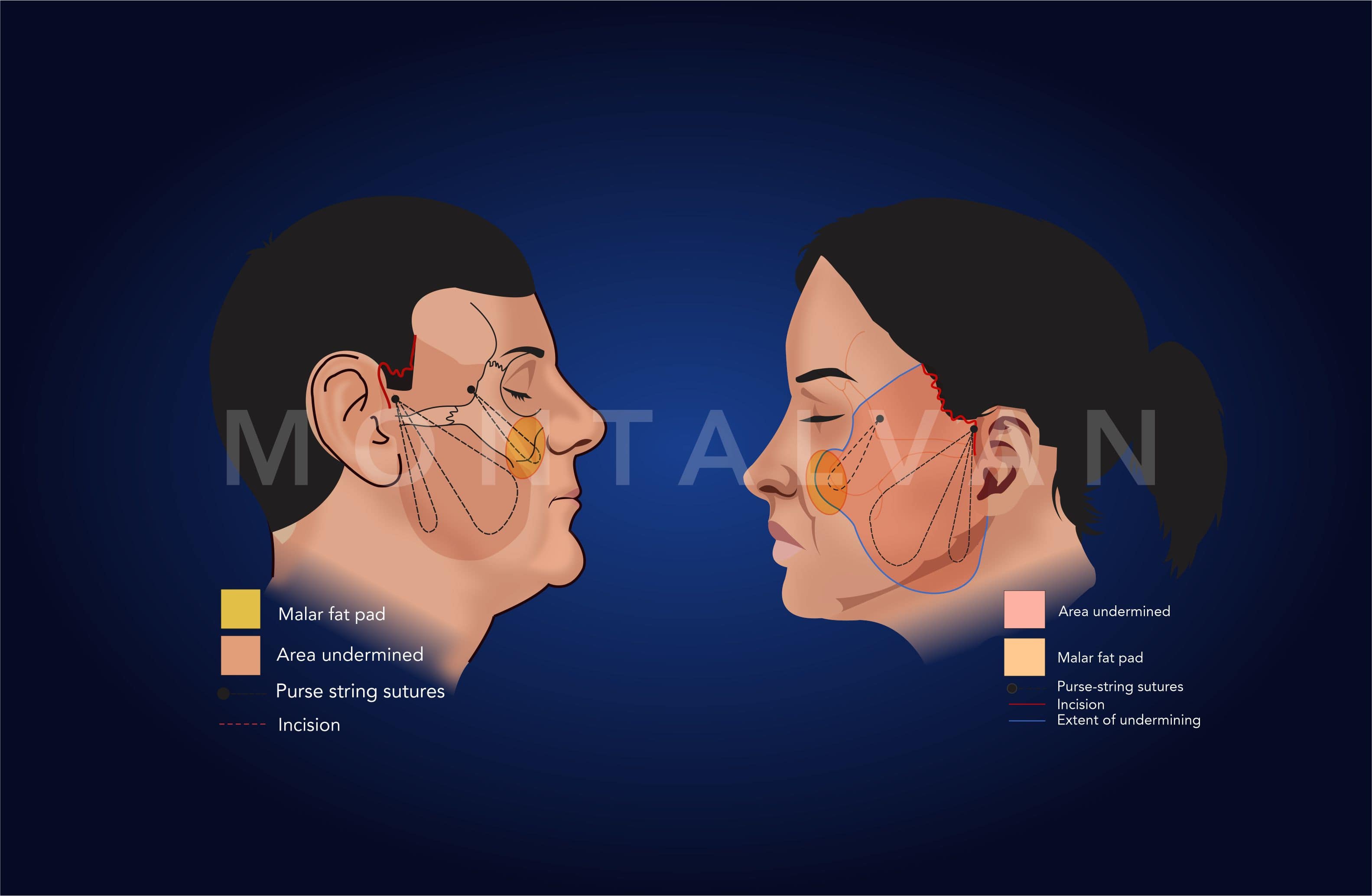 Can smoker's lines around the mouth be corrected with dermal filler? •  Illuminate Skin Clinics